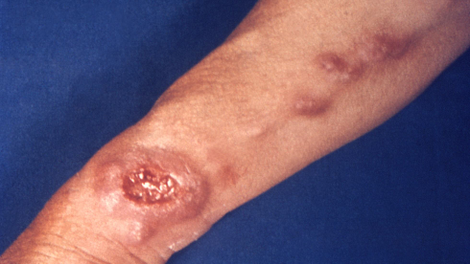A photo of cutaneous leishmaniasis, taken in 1965.